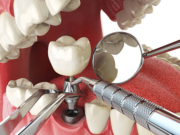 Best Emergency Dentist for Knocked-Out Tooth in Black Forest, CO